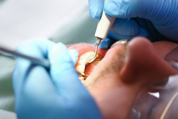 Best Emergency Tooth Extraction in Baldn, WI