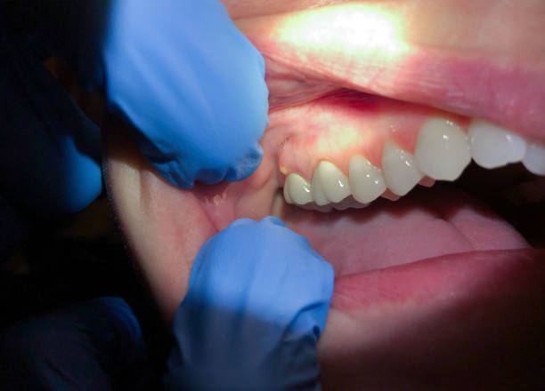 Best Emergency Treatment for Dental Infections or Abscesses in Baldn, WI